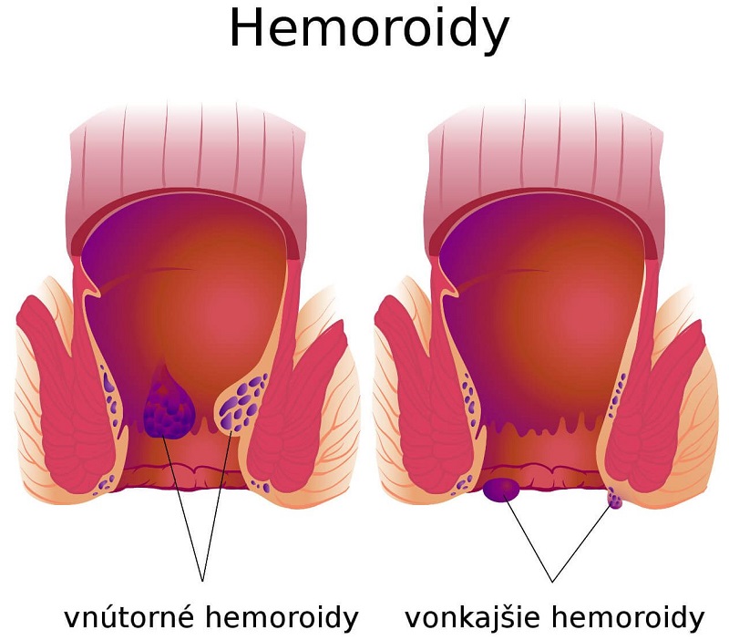 Vonkajšie hemoroidy a vnútorné hemoroidy